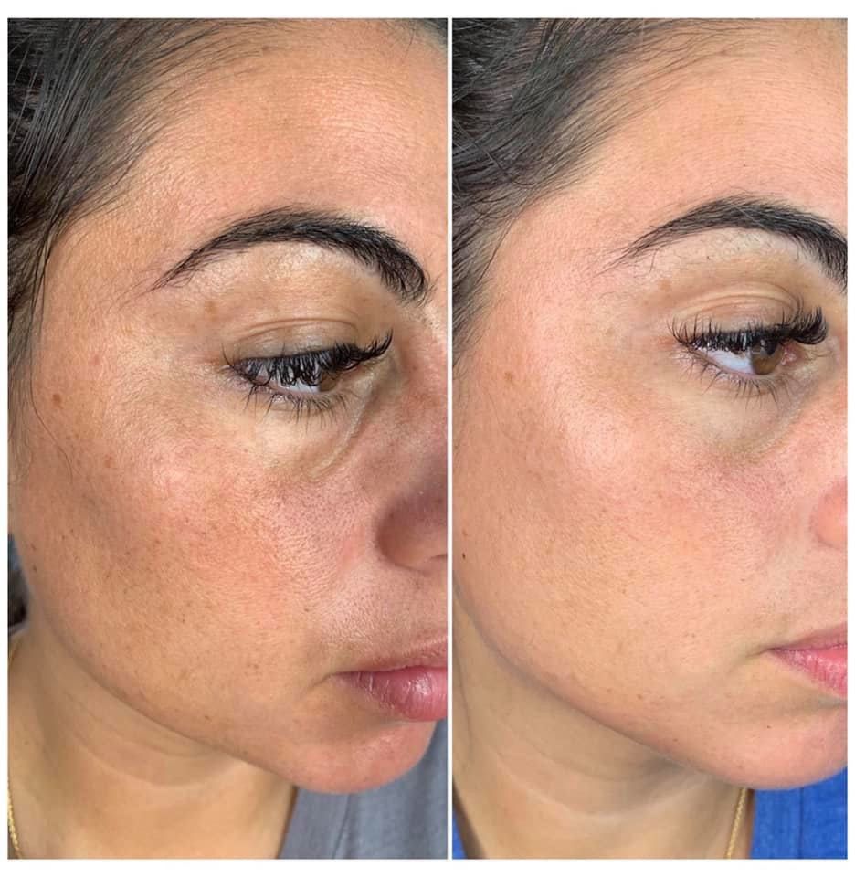 Collagen facial before and after, cheeks and jaw