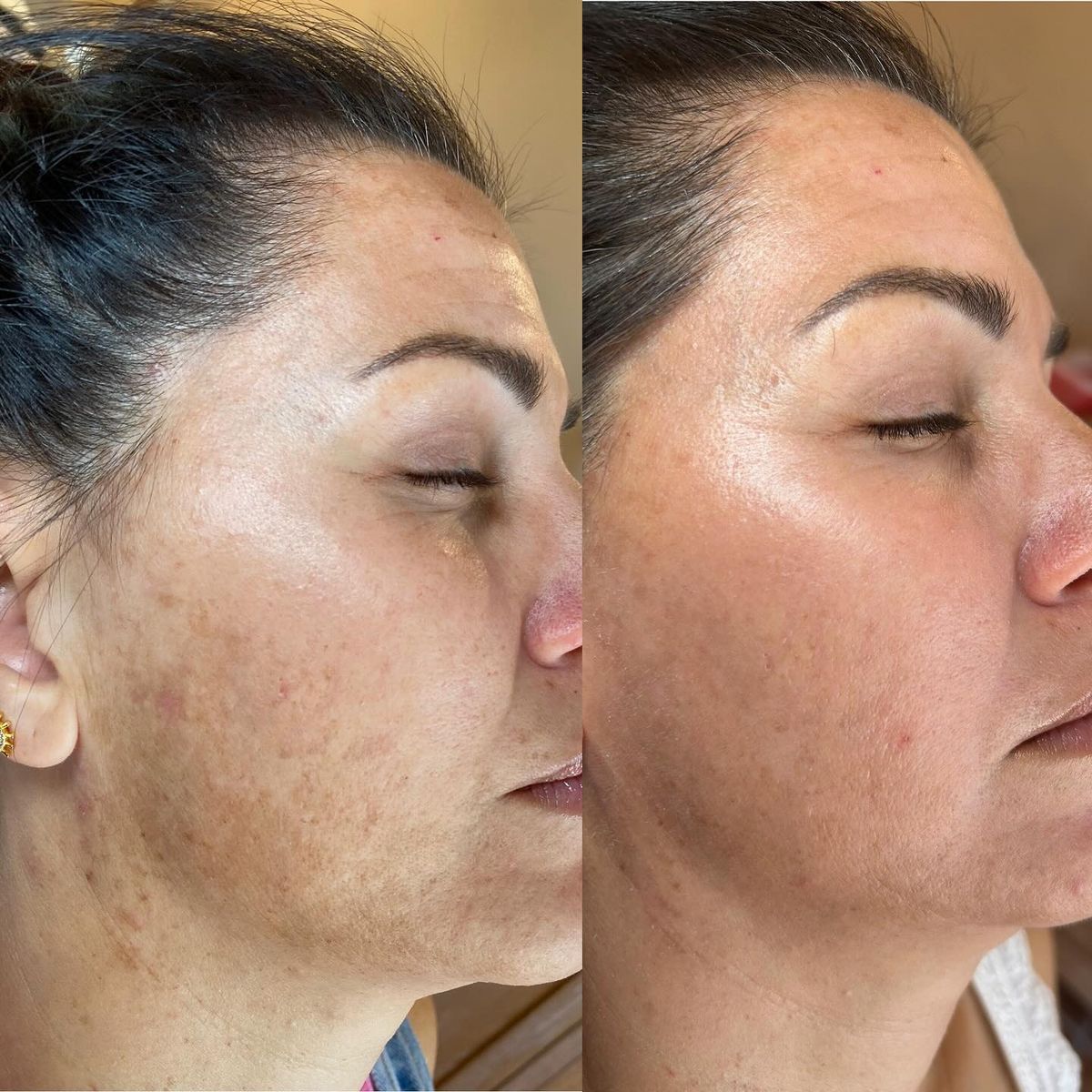 Collagen facial before and after, full face glow